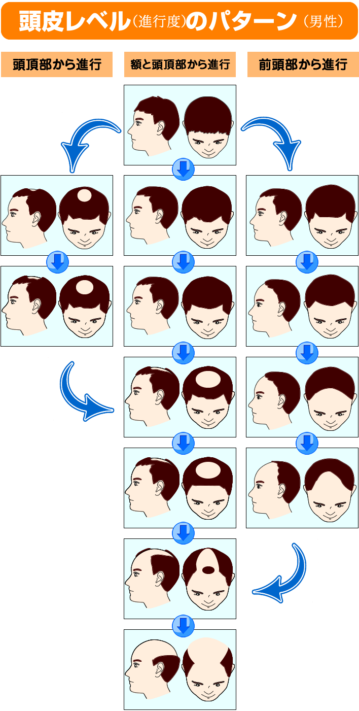 男性の頭皮レベル